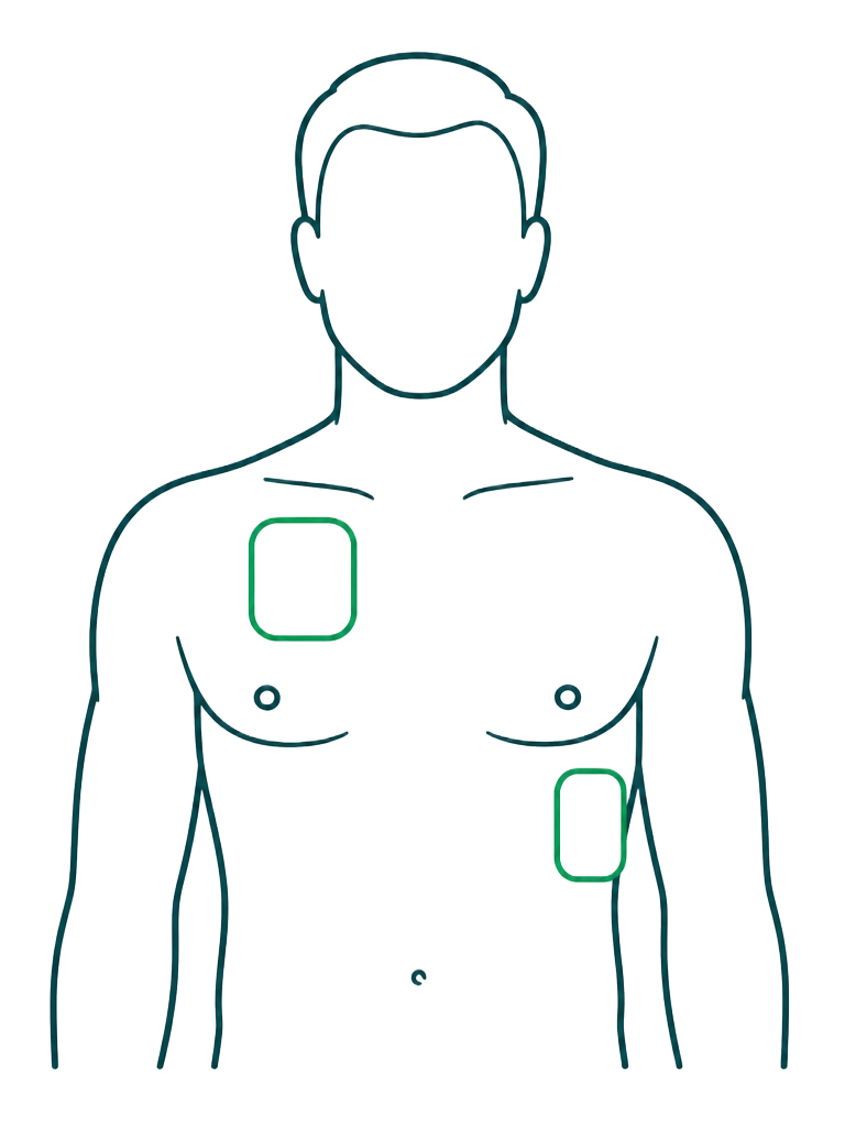 AED-Elektrodenposition